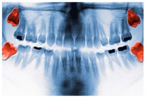 Yirmilik Diş Çıkması | Diş Hekimi